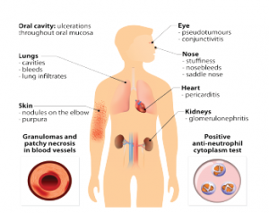 Granulomatosis With Polyangiitis Rates Outcomes The Rheumatologist