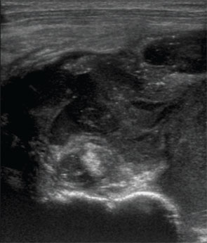 Diagnostic Imaging in Patient with Atraumatic Left Shoulder Pain ...