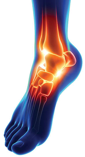 Ankle Replacement — Ankle Arthritis