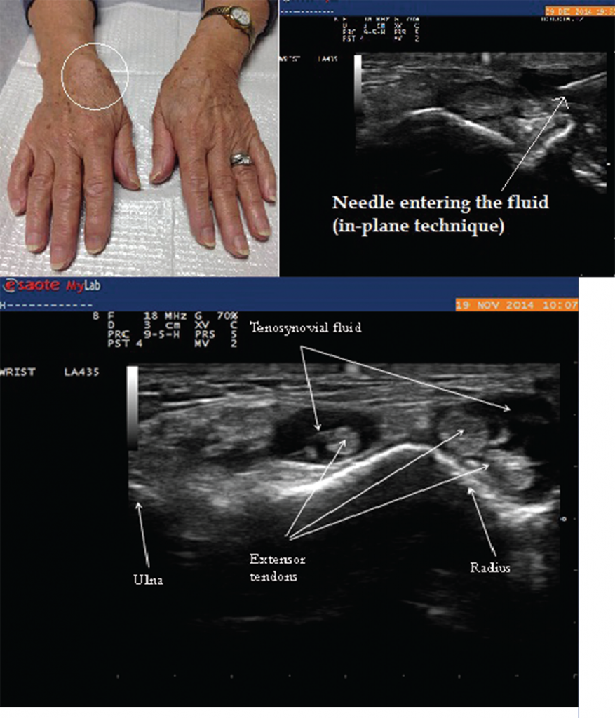 Musculoskeletal Ultrasound: A Valuable Tool for Diagnosing Rheumatic ...