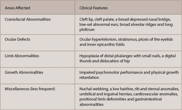 Rheumatology Case Report Hand Abnormalities Feature Of Fetal Hydantoin Syndrome The