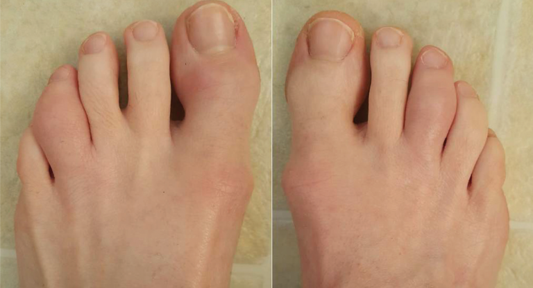 Case Report: A Psoriatic Arthritis Patient With Dactylitis & Enthesitis ...