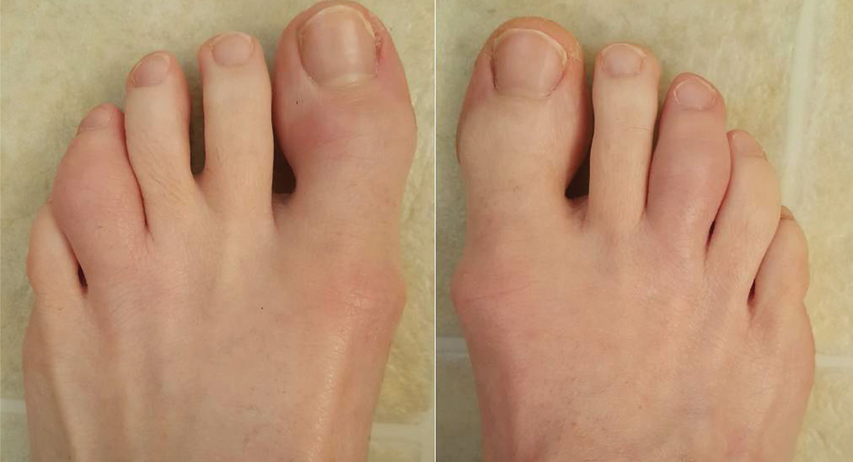 arthritis in little toe