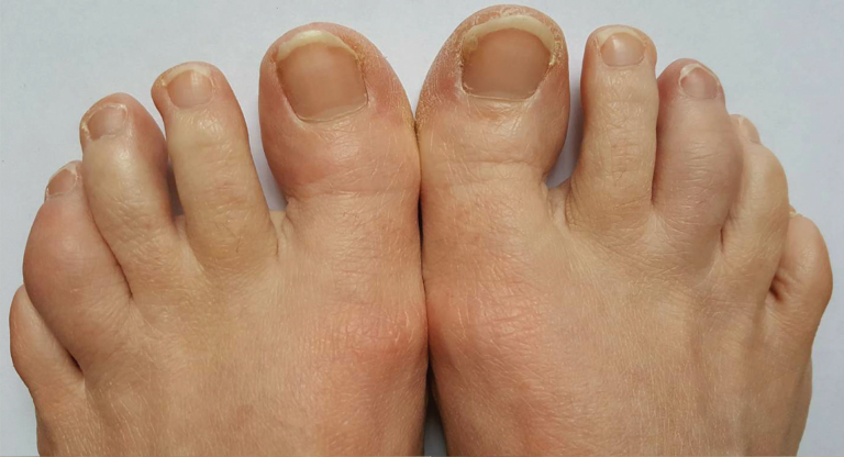 Case Report: A Psoriatic Arthritis Patient With Dactylitis & Enthesitis ...