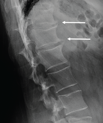 osteophytes lumbar anterior endplate l1 t12 retinoid acne hyperostosis rheumatologist l2 radiograph lateral demonstrating