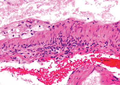 Case Report: Lymphocytic Vasculitis of the Central Nervous System ...