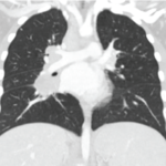 Figure 2: High-resolution computed tomography showed evidence of interstitial lung disease.