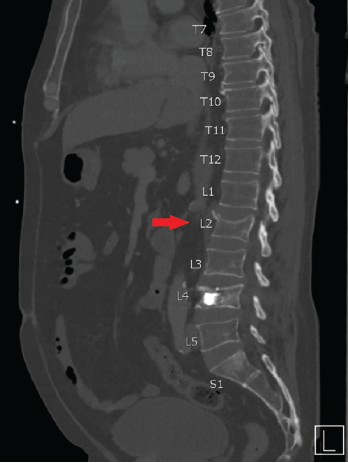 Compression fracture, Radiology Case