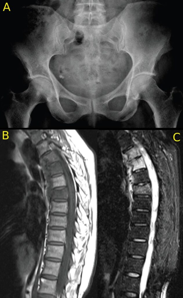 imaging-of-axial-psoriatic-arthritis-the-rheumatologist