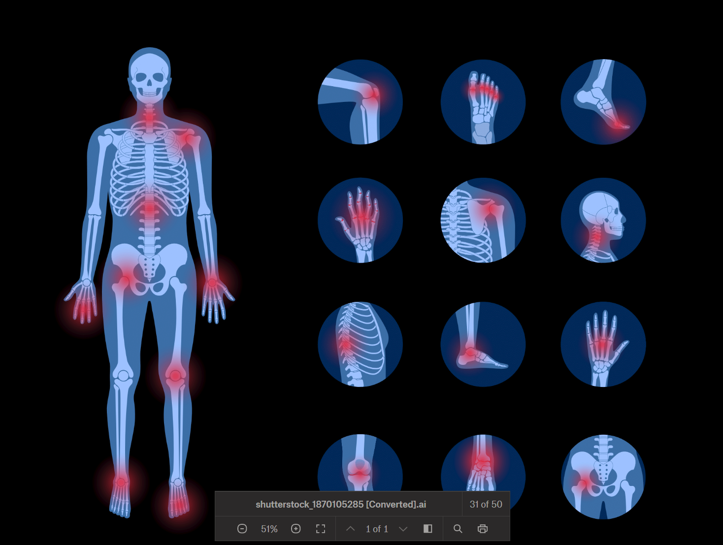 Case Report: Migratory Polyarthritis as the Presenting Symptom of GPA ...