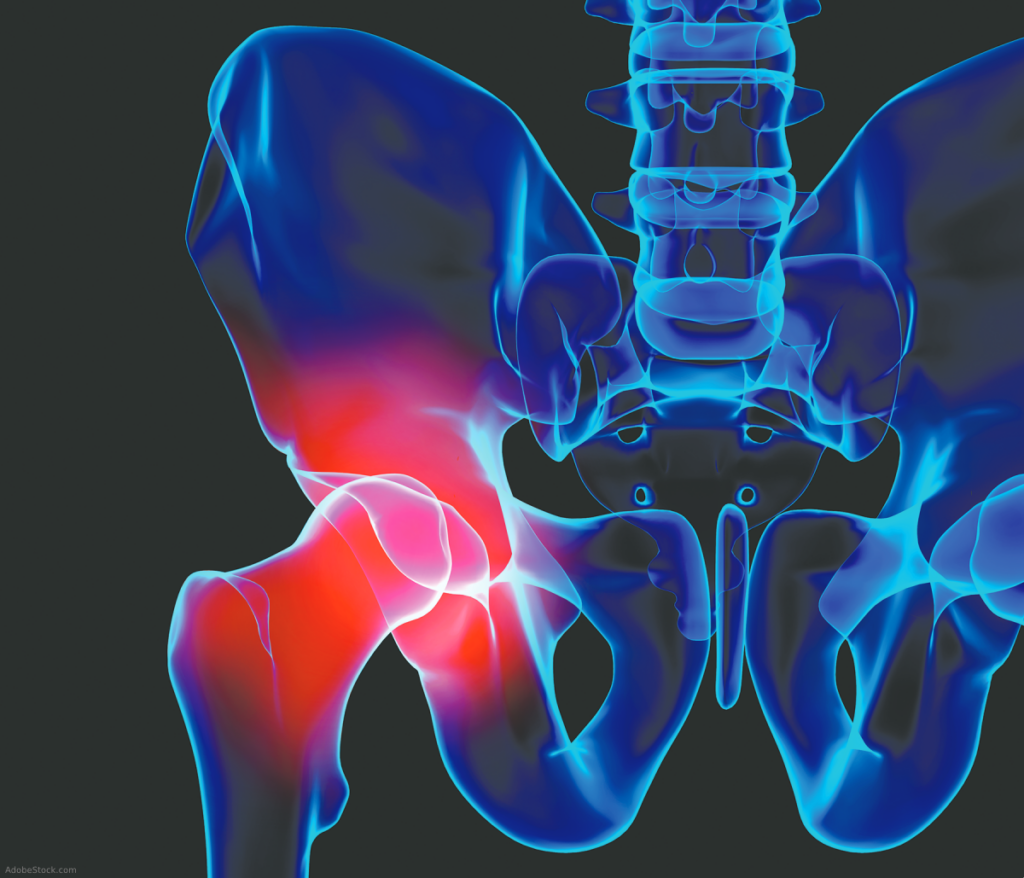 Drinking Raises Risk of Hip Replacement Due to OA - The Rheumatologist