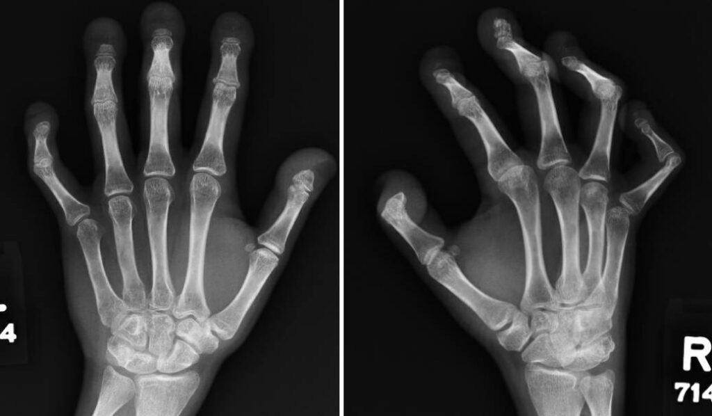 Case Report: Hajdu-Cheney Syndrome - The Rheumatologist