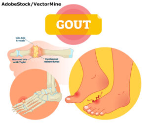 Gout vector illustration. Medical labeled scheme with uric acid crystals, masses of tophi. Diagnosis of swollen and inflamed foot joint. Painful anatomical bone disease.