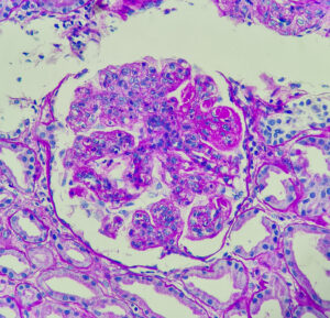 lupus nephritis, showing wire loop and hyaline thrombi, PAS stain, magnification 400x, photo under microscope