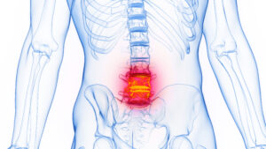 3D rendered Medical Illustration of Male Anatomy - Inflamed Lumbar Spine. Plain White Background.