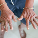 Skin disorder, pepper appearance from scleroderma, autoimmune disease male hand Skin disorder pepper appearance from vitiligo,scleroderma raynaud, medical concept autoimmune disease. Credit: Adobe Stock | Trsakaoe