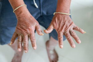 Skin disorder, pepper appearance from scleroderma, autoimmune disease male hand Skin disorder pepper appearance from vitiligo,scleroderma raynaud, medical concept autoimmune disease. Credit: Adobe Stock | Trsakaoe